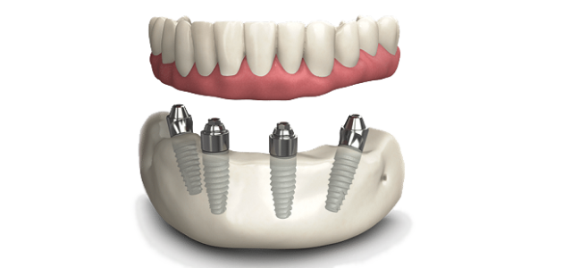 Протезирование all-on-4 в Краснодаре