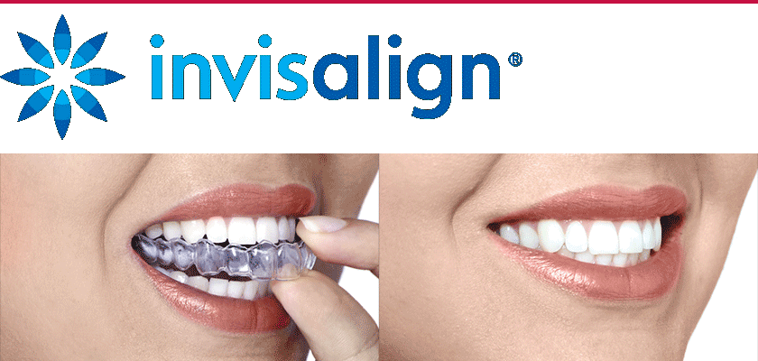 Элайнер Invisalign